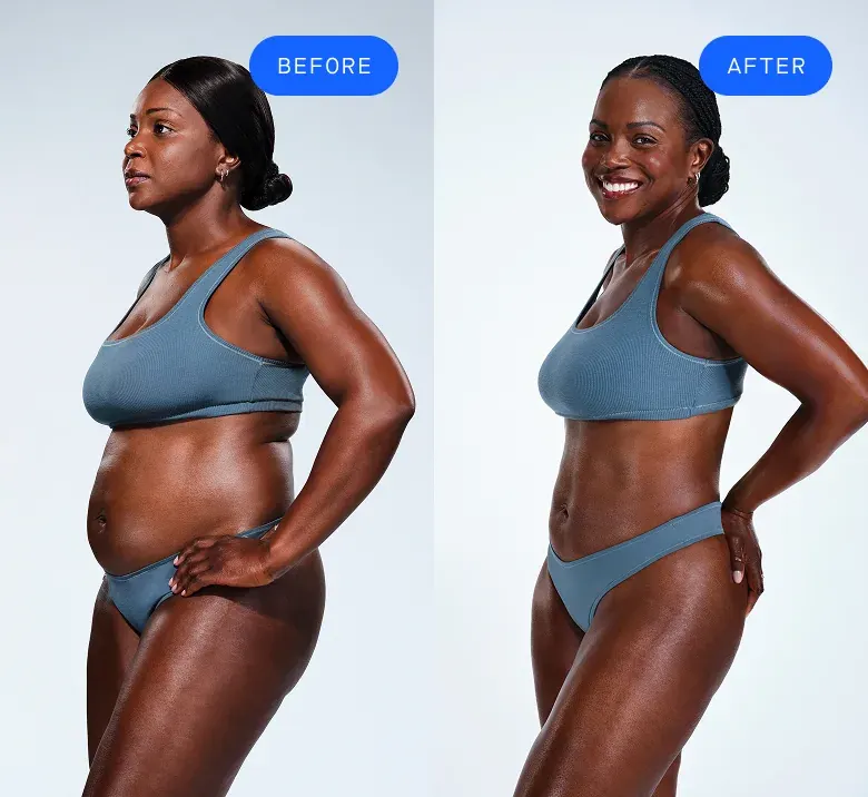 Before and after CoolSculpting patient comparison