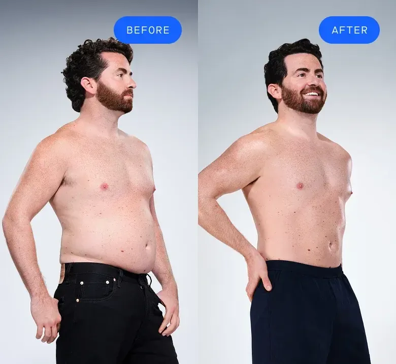 Before and after CoolSculpting patient comparison
