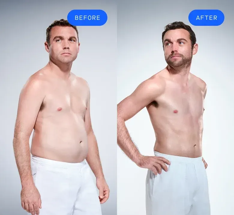 Before and after CoolSculpting patient comparison