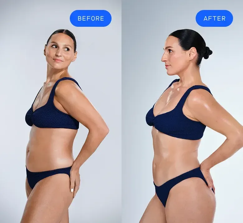 Before and after CoolSculpting patient comparison