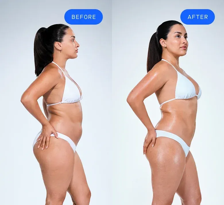 Before and after CoolSculpting patient comparison