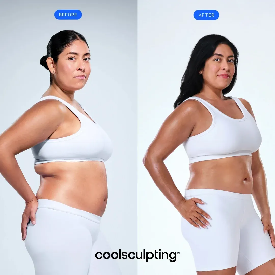 Before and after CoolSculpting patient comparison